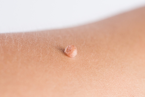 Skin,Tag,Or,Acrochordon,Or,Soft,Fibrom,Dermatology,Problem,On
